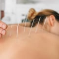 Reducing Stress and Anxiety with Acupuncture