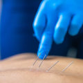Understanding Acupuncture Needles: A Comprehensive Guide