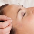 Facial Rejuvenation Acupuncture: A Holistic Approach to Pain Relief and Traditional Chinese Medicine