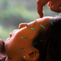 Improving Sleep Quality with Acupuncture
