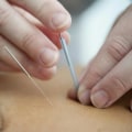 All You Need to Know About Fibromyalgia and Acupuncture