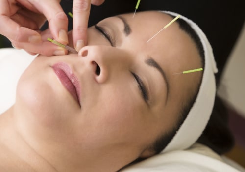 Acupuncture for Headaches and Migraines