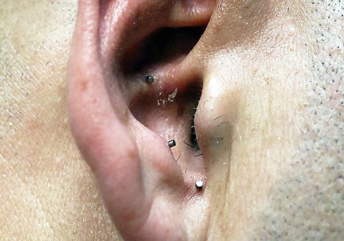 Auricular Acupuncture: A Comprehensive Guide to Pain Relief and Holistic Healing