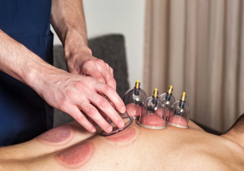 Cupping Therapy: A Holistic Approach to Pain Relief and Traditional Chinese Medicine
