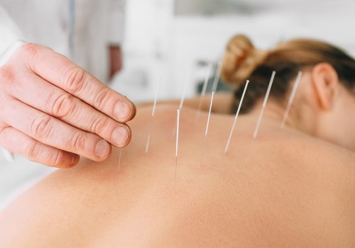Reducing Stress and Anxiety with Acupuncture