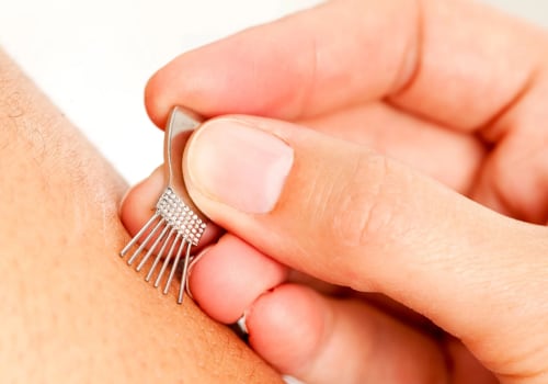All You Need to Know About Japanese Acupuncture