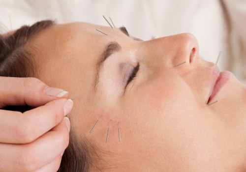 Facial Rejuvenation Acupuncture: A Holistic Approach to Pain Relief and Traditional Chinese Medicine