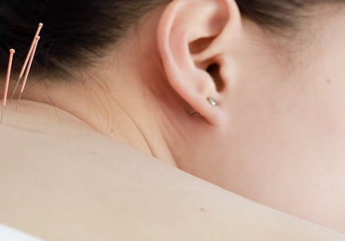 Acupuncture for Pain Relief: Understanding Traditional Chinese Medicine
