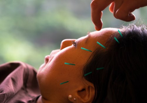 Improving Sleep Quality with Acupuncture