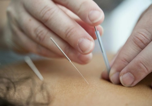 All You Need to Know About Fibromyalgia and Acupuncture